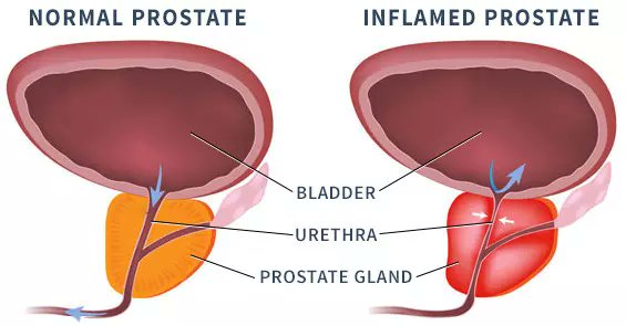 What Is Prostatitis?