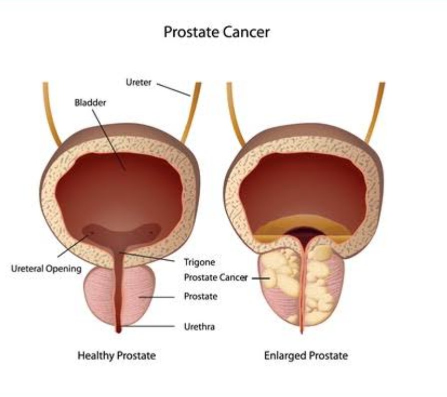 Risk Of Getting Prostate Cancer