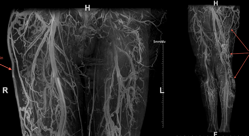 VASCULAR STUDIES/ DUPLEX